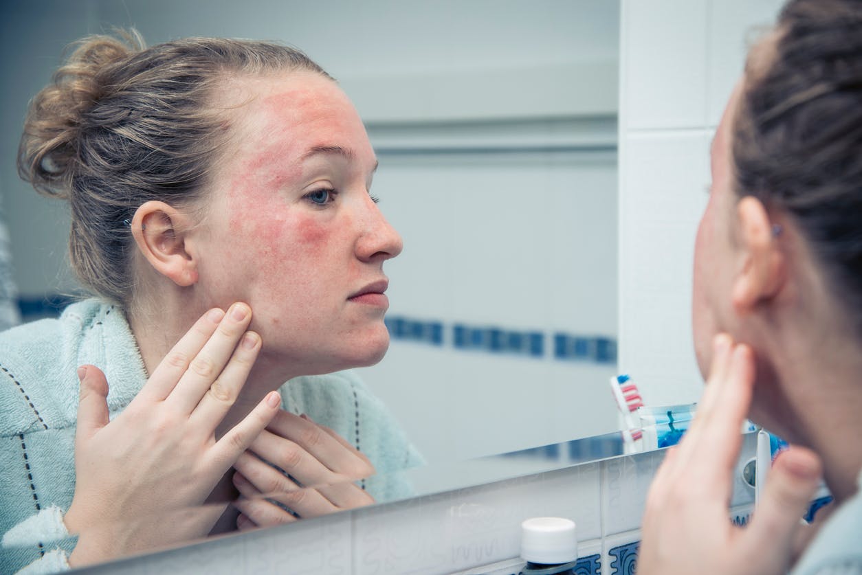 Comment reconnaître et traiter le psoriasis du visage ?