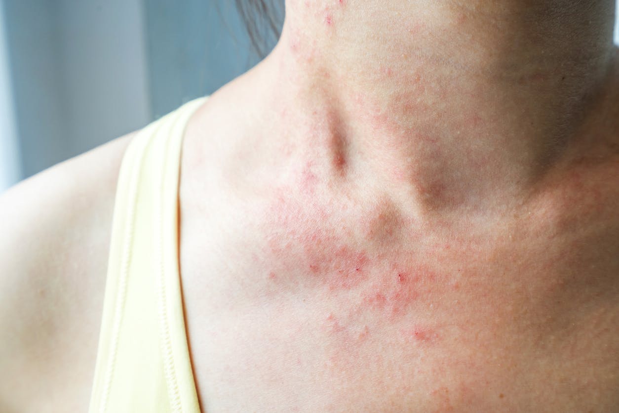 Comment traiter l’eczéma ?