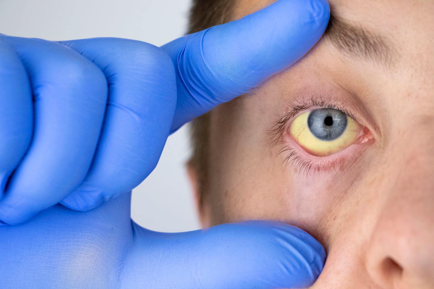 Yeux jaunes : quelles causes ? Quand consulter ?